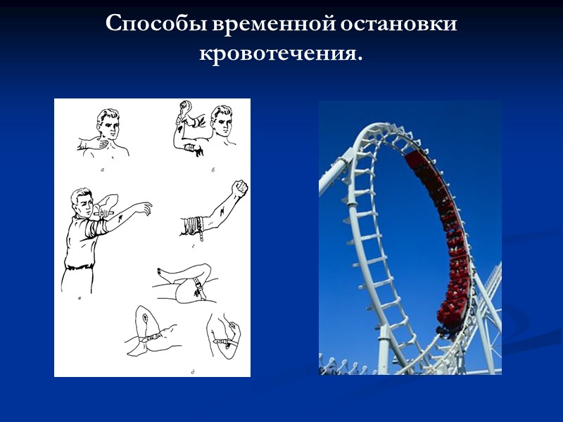 Cпособы временной остановки кровотечения.